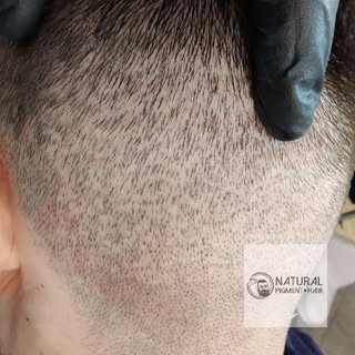FUE NARBEN SCHLIEßEN 👍
KEIN PROBLEM 💪

#HAARPIGMENTIERUNG #fue #fut #smp