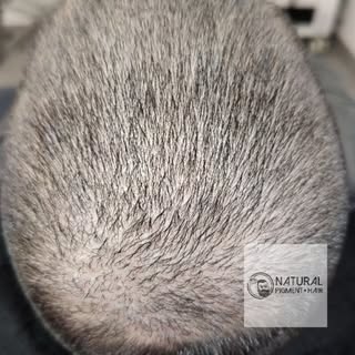 OPTISCHE HAARVERDIVCHTUNG
Volleres Haar mit der Haarpigmentierung bei Natural Pigment Hair in Augsbu