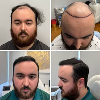 ✨ 11 Months Post-Op ✨
What a transformation! 🙌

This patient came to Precision Medical Hair Restora