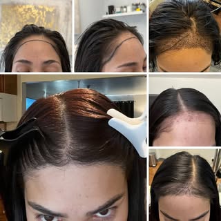 ✨ 7 Months of Growth, A Lifetime of Confidence ✨

This young female patient came to us wanting a ful
