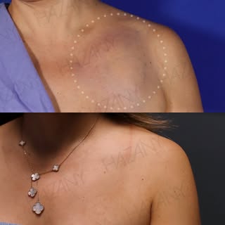 Lipomas are benign, slow-growing collections of fat tissue that form just under the skin. They are n