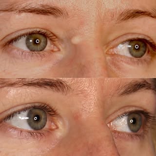 Mole reduction is a procedure that we perform when a client wants to make their mole less noticeable