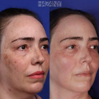 Five year before and after Erbium YAG
Laser Resurfacing (NOT CO2) 
Downtime: 5 days 

Laser resurfac