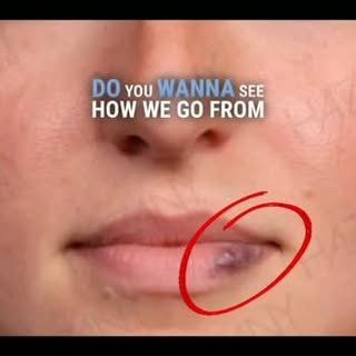 A birthmark on the lip can be distracting. In this case, a hemangioma or blood vessel tumor covering
