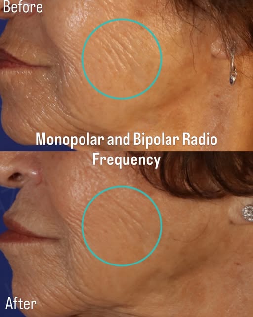 We have the best radio frequency skin tightening device andprotocol available. In the below before a