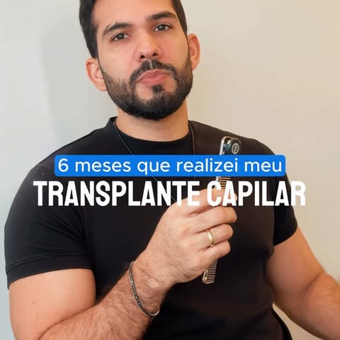 6 meses do meu transplante capilar. E aí… será que deu certo? 👀

Hoje eu não estou mostrando o resu