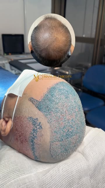 Giga Sessão + BHT ( Body Hair Transplantation )✅

Em casos de calvície avançada, alcançar uma boa co