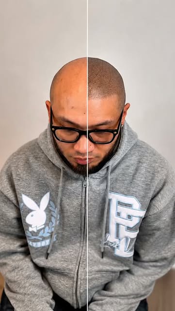 A new hairline can completely change your look. ✨ Scalp Micropigmentation (SMP) creates the appearan