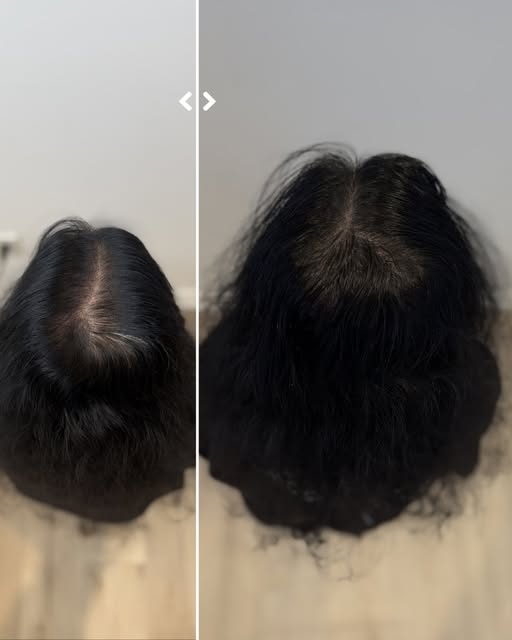 ✔️No filters ✔️No fibers ✔️No tricks. Just strategically placed Scalp Micropigmentation creating the