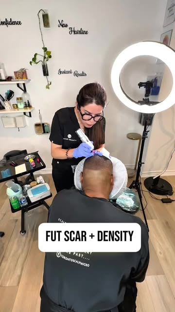 Concealing FUT scar and thinning hair. Treated together for a more balanced result. I used SMP to ca