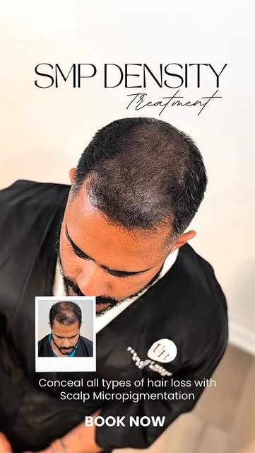 He came in with thinning hair and visible scalp… and this is what he left with. 🙌 By adding SMP bet