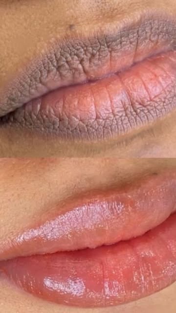 Dark lip color correction at Lanina Aesthetic center Ahmedabad 

Lip pigmentation darkness blackness