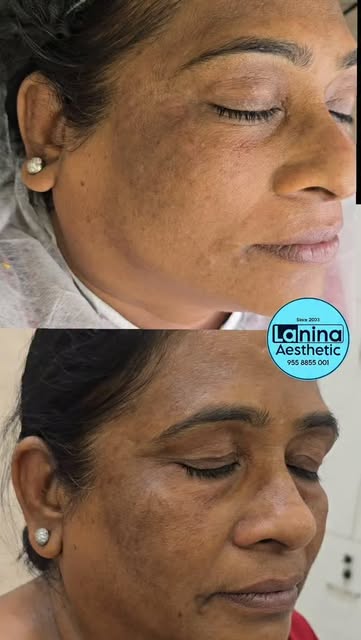 1st session results (immediate after)
Pigmentation Uneven skin tone black patches open pores dullnes