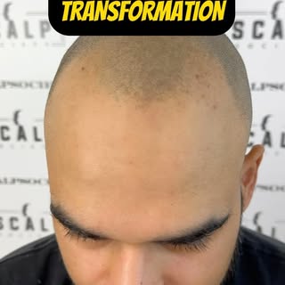 If you’re going through any form of hair loss whether it’s just a receding hairline or a full male p