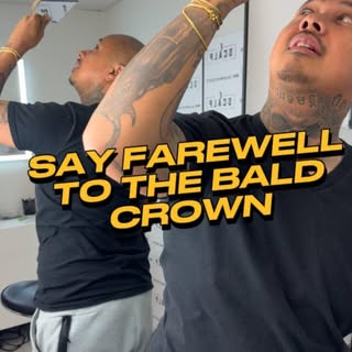Anyone looking to go through the Scalp Micropigmentation with us is assured to receive the absolute 