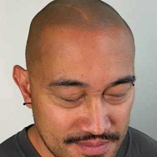 Enjoyed completing this one. Client requested that we leave the scar alone for his treatment. 

————