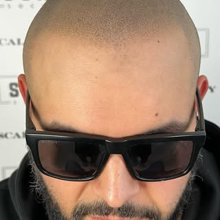 🍂 FEATHERED & FADED
✅ NATURAL SHAPE
🏆 GRAINY EFFECT

—————————————————-

#scalpmicro #alopecia #ha