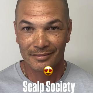 Major confidence booster!
#scalpmicropigmentation #smp #scalptattoo #scalptattooing #baldness #baldh