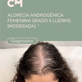 ¿Es posible frenar la pérdida de densidad capilar en mujeres jóvenes sin recurrir a una cirugía? La 