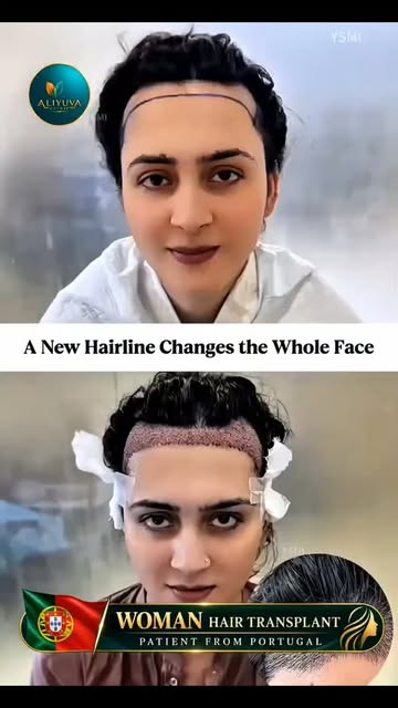 ✨ WOMAN HAIR TRANSPLANT IN ISTANBUL

Not every woman is happy with her natural hairline. A high fore
