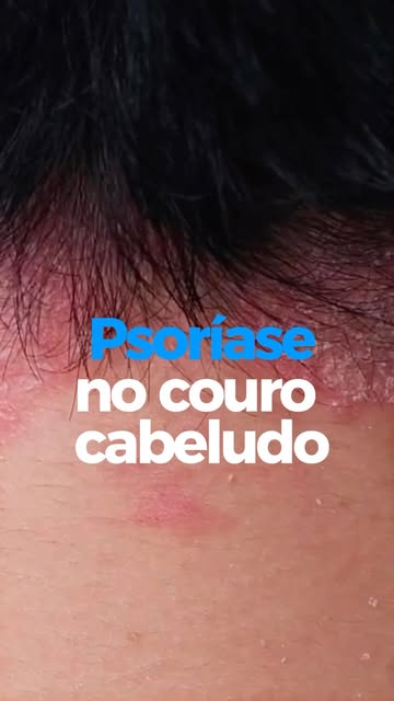 Teu couro cabeludo melhora... e algum tempo depois as placas, a descamação e a coceira aparecem nova