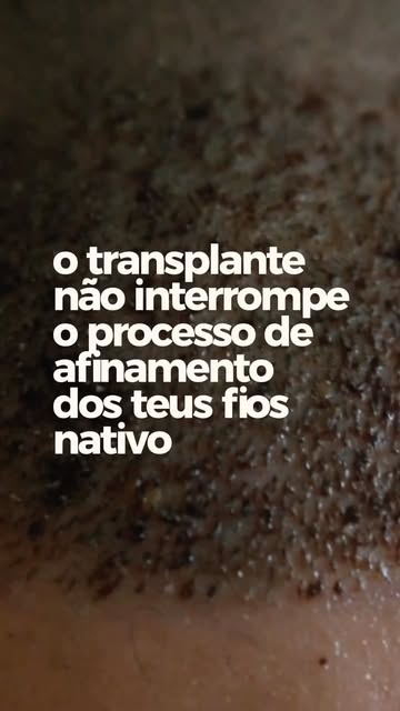 Os fios transplantados cresceram. E os fios nativos?

O transplante capilar reposiciona folículos, m