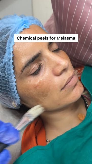 Chemical peeling for Melasma and pigmentation 
#melasmas #chemicalpeel #dermatologist #jaipurskincli