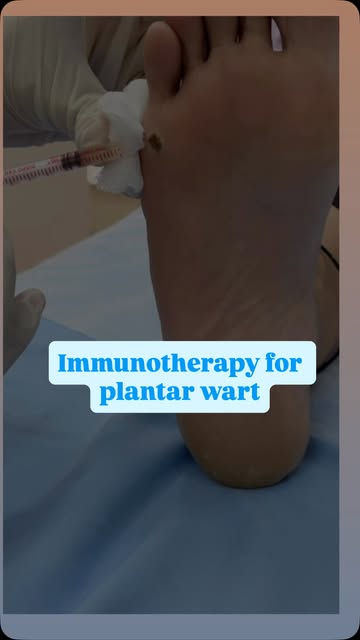 Immunotherapy is an advanced medical treatment used to clear stubborn, painful, or multiple plantar 