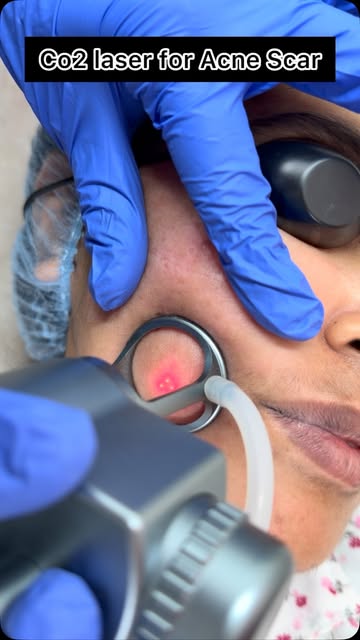 Acne Scar treatment with fractional CO2 laser
#dermatologist #jaipurskinclinic #acnescartreatment #f