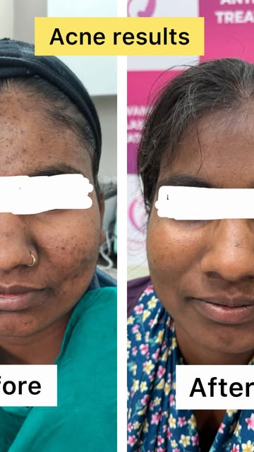 “ ✨From active acne to healthier looking skin- Every journey takes time ✨
Clearer skin begins with r