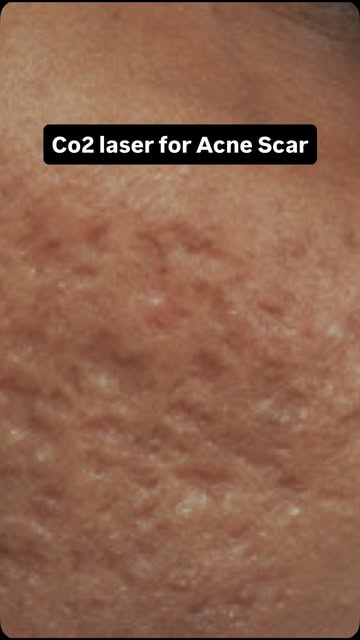 From Acne scar to smoother looking Skin
#acnescartreatment #fractionalco2laser #dermatologist #jaipu
