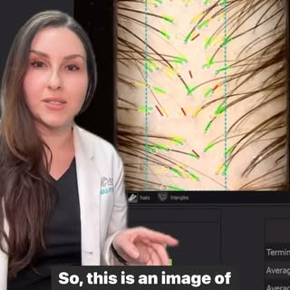 What does Androgenic Alopecia look like at 60x magnification? Our Trichoscopy reading helps our spec