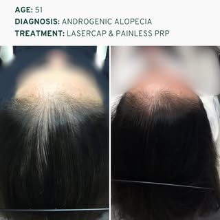Female pattern hair loss doesn’t always look like a widening part.⁠
⁠
For this 51-year-old patient, 