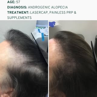 Hair loss treatment works best when we look at the whole picture.⁠
⁠
This 57-year-old patient came t