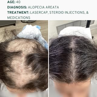 Alopecia areata can cause significant hair loss, sometimes seemingly out of nowhere. But what’s actu