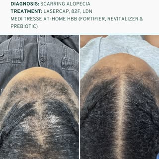 What can treatment do when the diagnosis is scarring alopecia?⁠
⁠
For this 57-year-old Medi Tresse p