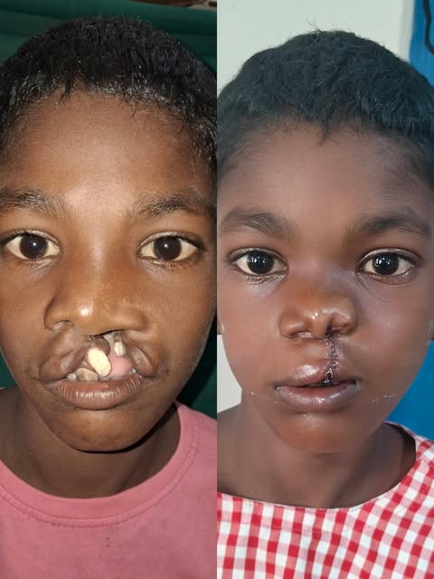 Transforming Lives:

When the dressing was opened on the 1st post operative day, this young boy's st