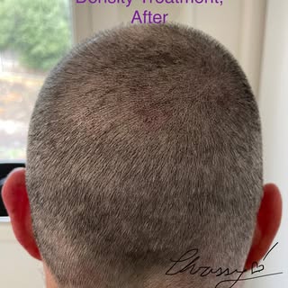 Density treatment before and after. I must remember to take more photos as one is blurry ☺️

📞 0425