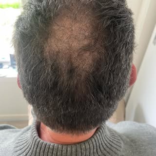 Hair density after SMP and before SMP. This was after a third session. Sessions are around 4 hours e