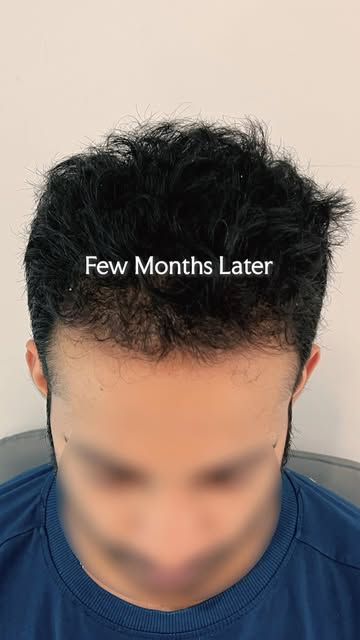 👇 Some hair transplant results are more than a before and after. They become part of a surgeon’s jo