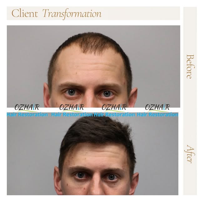 Book your free evaluation now!

📱 +1 (631) 682-6545

#hairtransplant #hairsurgery #haireducation #h