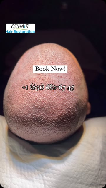 Hairtransplant surgery 

Book your free evaluation now!
#hairtransplant #hairtransformation #hairsty