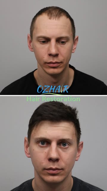 Hair Transplant Transformation! 

Looking for natural and long-lasting hair restoration results?
Our