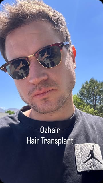 Hair transplant in Newyork 👨‍⚕️👨‍⚕️
#hairstylist #hairtransplant #hair #haircut #hairproduct