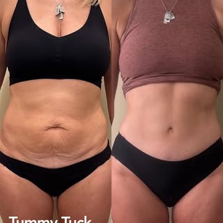 A flatter, fitter, and more toned abdomen! ✨
#westaesthetics