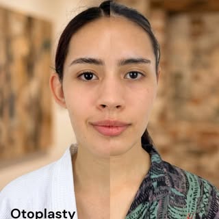 Precision in symmetry.

➡️ Swipe for details
📩 DM for consultation

#otoplasty #otoplastía 

Design