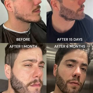 Beard Transplant Transformation ⚡️

6 months later… The density speaks for itself. 🧔‍♂️