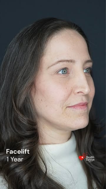 A true transformation journey from day one to 1 year post-op. Discover what comprehensive facial arc
