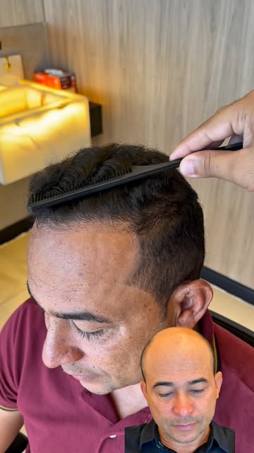 Calvície grau 7 restaurada em 2 sessões, com extrema naturalidade e densidade adequada para o caso!!