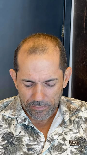 Calvícies extensas exigem planejamento correto e priorização de algumas regiões para um resultado sa